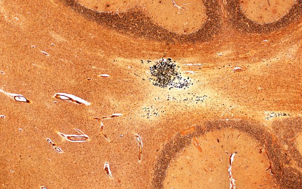 6C4C Cerebroretinal Vasculopathy, CRV, RVCL, TREX, HERNS, Case 6) Biels 4X