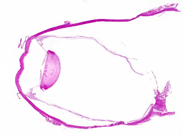 6E1 Cerebroretinal Vasculopathy, CRV, RVCL, TREX, HERNS, Case 6) H&E Eye