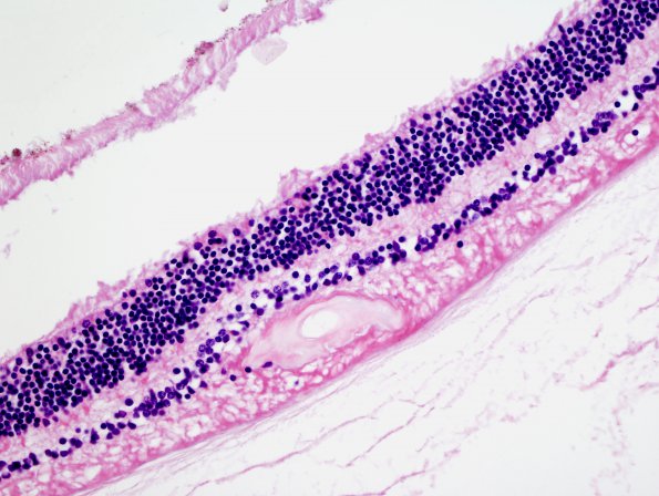 6E2 Cerebroretinal Vasculopathy, CRV, RVCL, TREX, HERNS, Case 6) H&E 1 retina