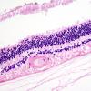 6E3 Cerebroretinal Vasculopathy, CRV, RVCL, TREX, HERNS, Case 6) H&E 2 retina