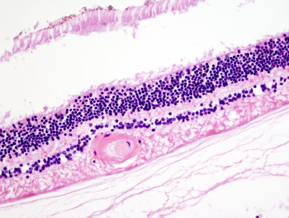 6E3 Cerebroretinal Vasculopathy, CRV, RVCL, TREX, HERNS, Case 6) H&E 2 retina