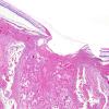 6E4 Cerebroretinal Vasculopathy, CRV, RVCL, TREX, HERNS, Case 6) H&E Eye & Optic Nerve 4