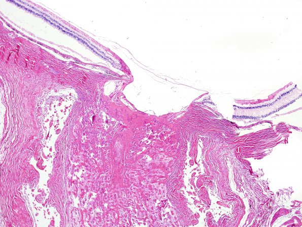 6E4 Cerebroretinal Vasculopathy, CRV, RVCL, TREX, HERNS, Case 6) H&E Eye & Optic Nerve 4