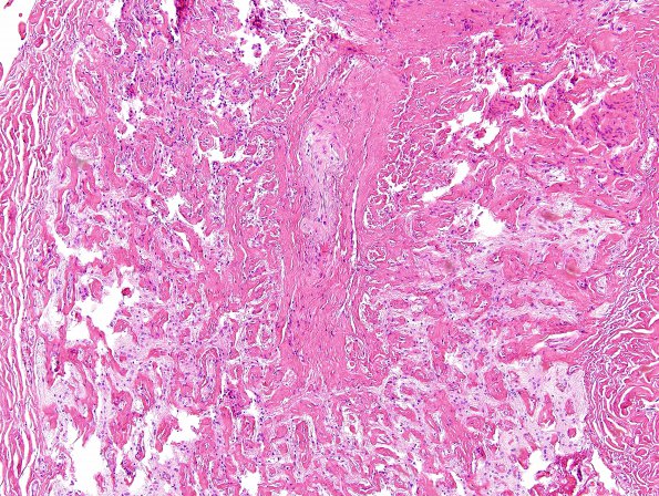 6E5 Cerebroretinal Vasculopathy, CRV, RVCL, TREX, HERNS, Case 6) H&E Eye & Optic Nerve 3