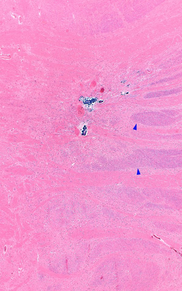 6F2 Cerebroretinal Vasculopathy, CRV, RVCL, TREX, HERNS, Case 6) N7 2X copy