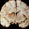 7A Cerebroretinal Vasculopathy, CRV, RVCL, TREX, HERNS, Case 7) 1