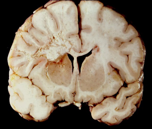 7A Cerebroretinal Vasculopathy, CRV, RVCL, TREX, HERNS, Case 7) 1