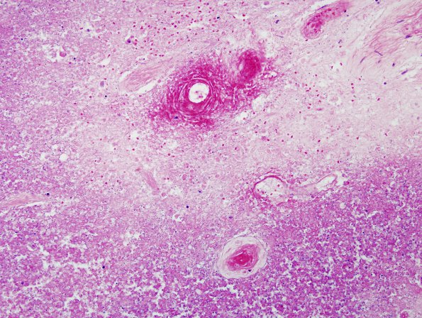 7B3 Cerebroretinal Vasculopathy, CRV, RVCL, TREX, HERNS,  Case 7) H&E 2