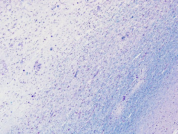 8B2 Cerebroretinal Vasculopathy, CRV, RVCL, TREX, HERNS, (Case 8 LFB-PAS 10X match Biels