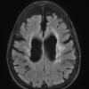 9A1 TREX Mutation encephalopathy (Case 9) 2016 T2 FLAIR - Copy