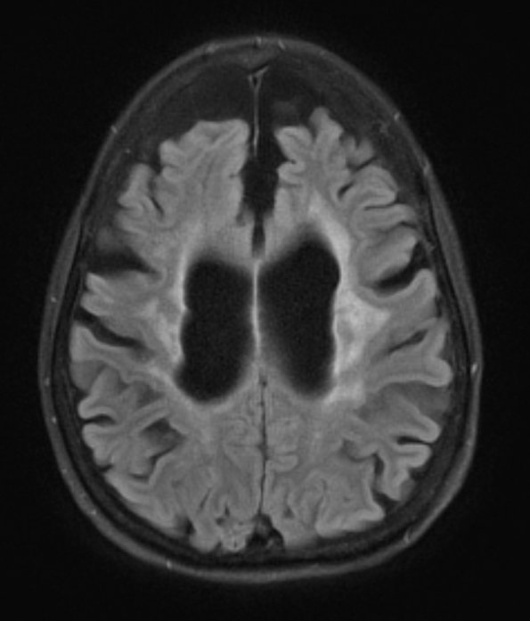 9A1 TREX Mutation encephalopathy (Case 9) 2016 T2 FLAIR - Copy