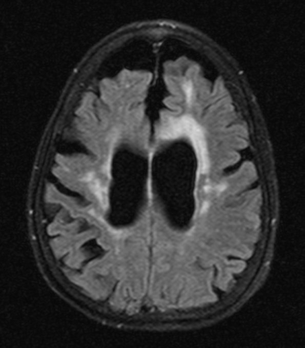 9A2 TREX Mutation encephalopathy (Case 9)2015 Tirm dark fluid - Copy