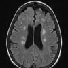 9A3 TREX Mutation encephalopathy (Case 9) 2011 T2 - Copy