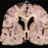 9B1 TREX Mutation encephalopathy (Case 9) _1