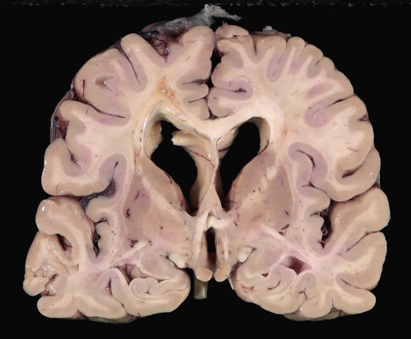 9B1 TREX Mutation encephalopathy (Case 9) _1