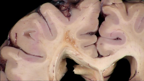 9B2 TREX Mutation encephalopathy (Case 9) _2