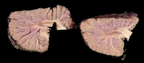 9B3 TREX Mutation encephalopathy (Case 9) _9