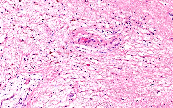 9C3 TREX Mutation encephalopathy (Case 9) N11 H&E 20X