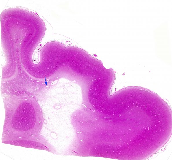 1B4 Canavan's Dz (Case 1) 2 copy