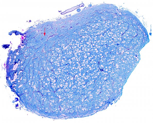 1C2 Canavan's Dz (Case 1) LFB-PAS 4X copy