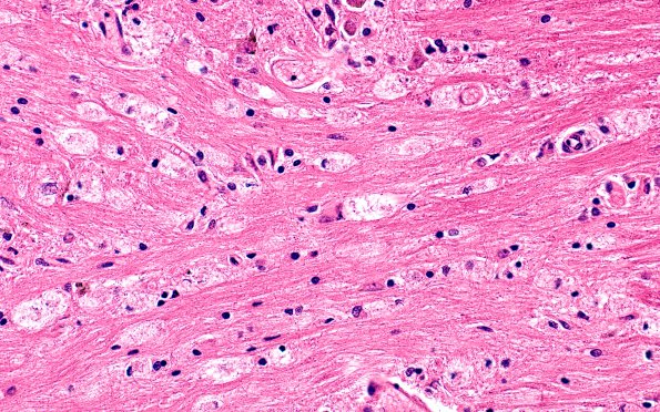 10C4 CPM (Case 10) H&E 40X