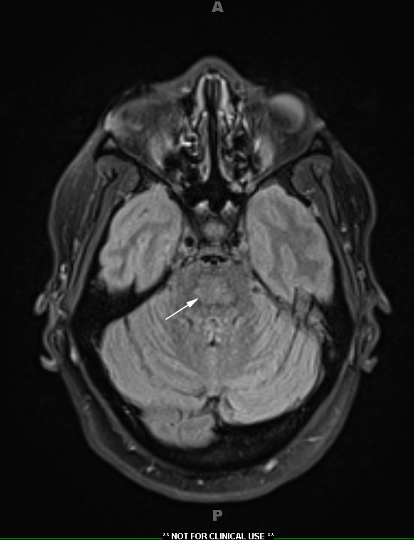 2A2 CPM (Case 2) FLAIR 2 copy - Copy