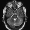 2A3 CPM (Case 2) T2 with contrast 1 - Copy