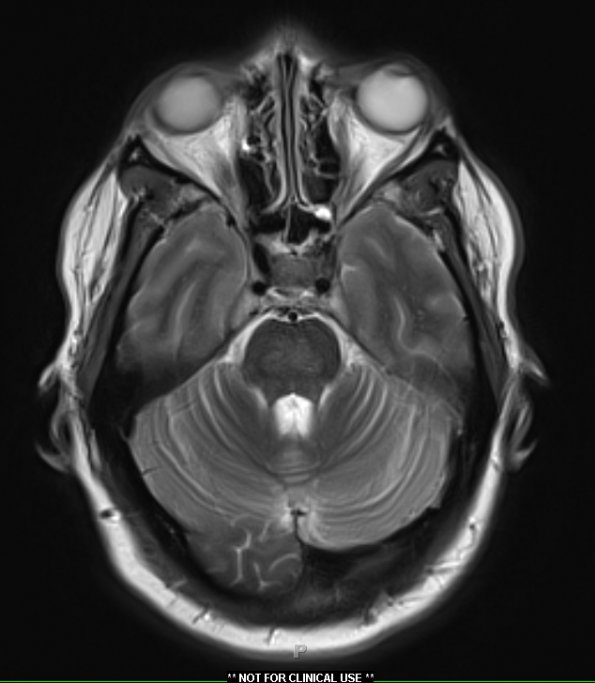 2A3 CPM (Case 2) T2 with contrast 1 - Copy