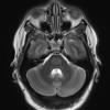 2A4 CPM (Case 2) T2 with contrast 2 - Copy