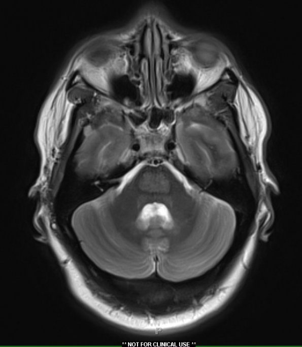 2A4 CPM (Case 2) T2 with contrast 2 - Copy