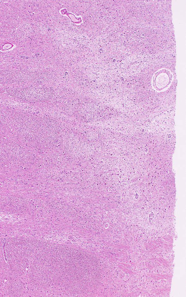 2C2 CPM (Case 2) N7 H&E 4X match with LFB-PAS & NF