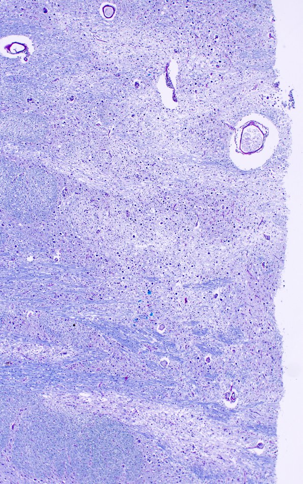 2C4 CPM (Case 2) N7 LFB-PAS 4X match with NF