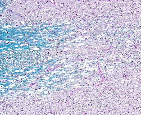 8B3 CPM (Case 8) LFB-PAS 10X 2