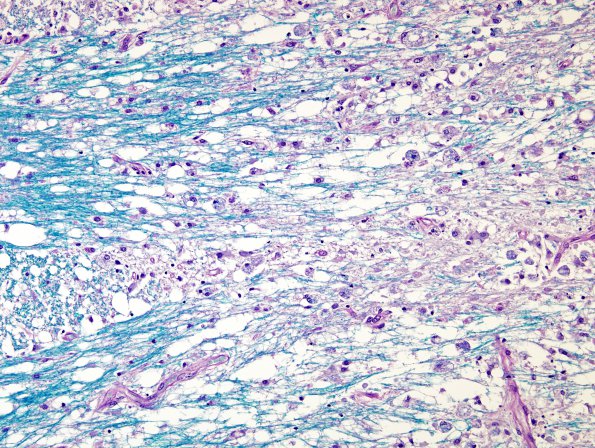 8B5 CPM (Case 8) LFB-PAS 20X  3