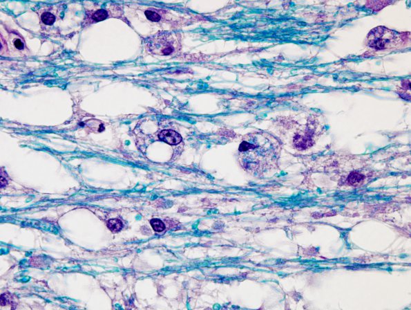 8B9 CPM (Case 8) LFB-PAS 100X