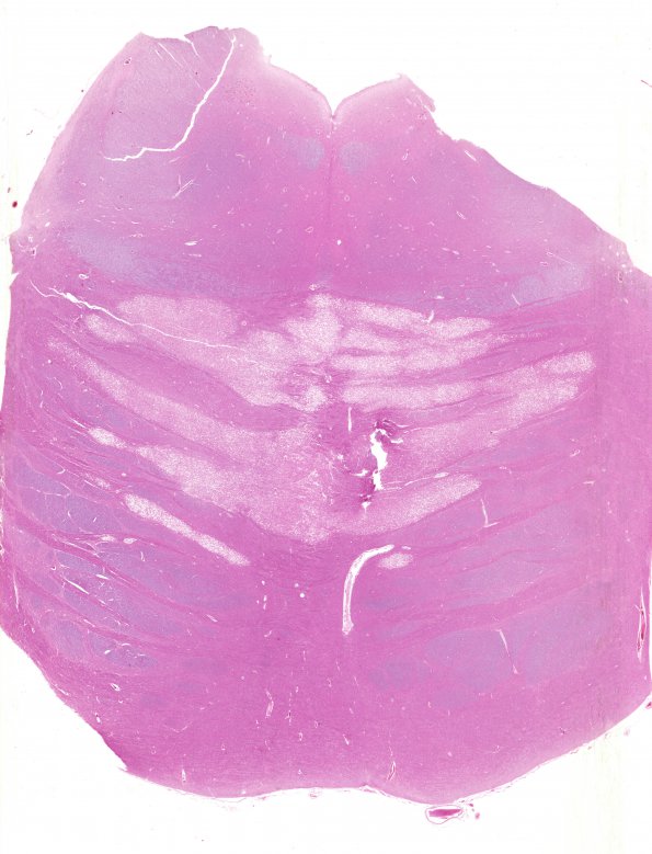 9B1 CPM (Case 9) N7 H&E WM
