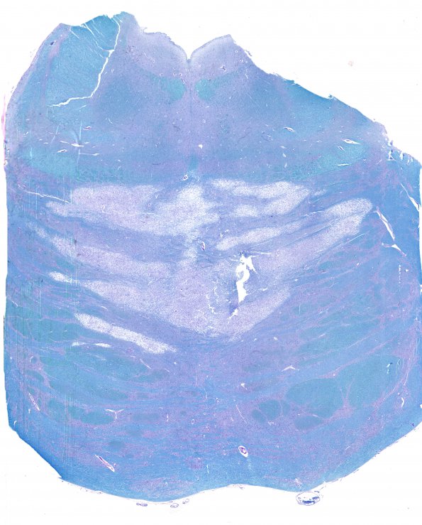 9B2 CPM (Case 9) N7 LFB-PAS WM