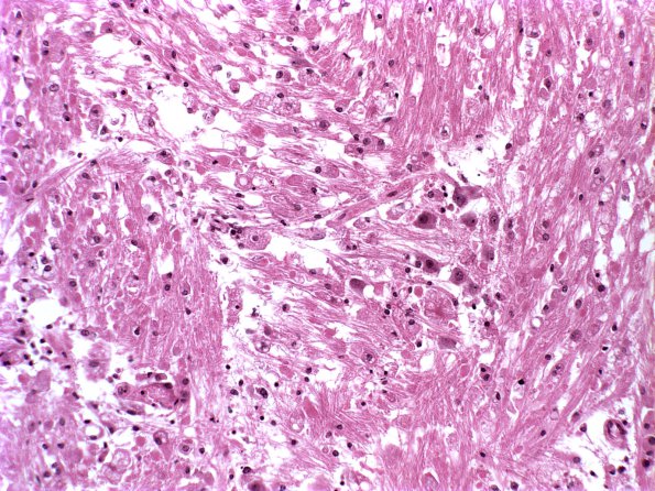 9C CPM (Case 9) H&E 1