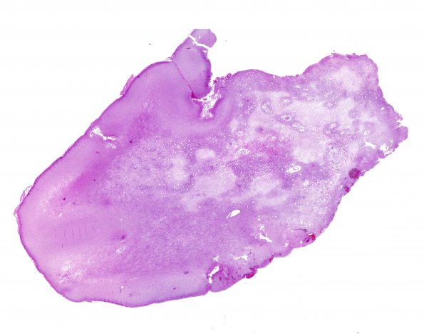 10A1 Radiation Necrosis (Case 10) H&E whole mount 1