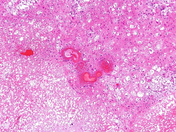 10A4 Radiation Necrosis (Case 10) H&E 4