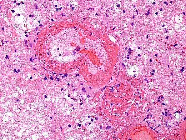 10A5 Radiation Necrosis (Case 10) H&E 3