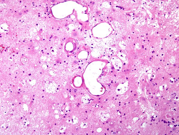 10A6 Radiation Necrosis (Case 10) H&E 2