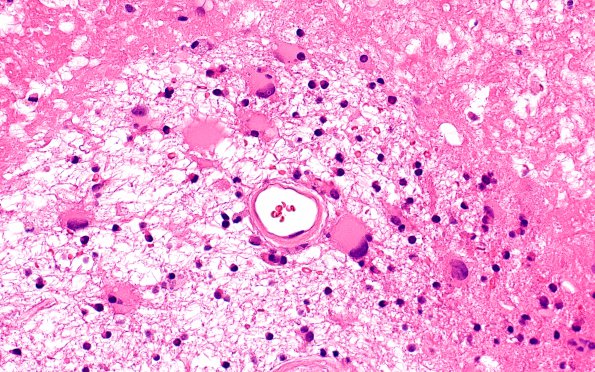 10A7 Radiation Necrosis (Case 10) H&E 7