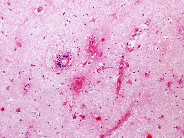 11A1 Radiation Encephalopathy (Case 11) H&E 1