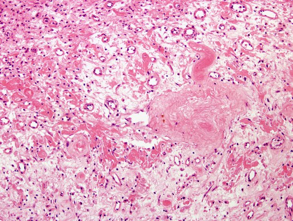 11A2 Radiation Encephalopathy (Case 11) H&E 2