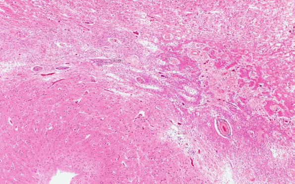 12A1 Radiation Encephalopathy (Case 12) H&E 2X