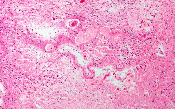 12A2 Radiation Encephalopathy (Case 12) H&E 10X 3