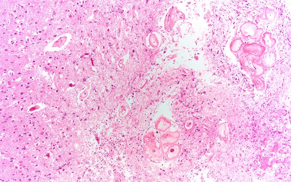 12A3 Radiation Encephalopathy (Case 12) H&E 10X 2