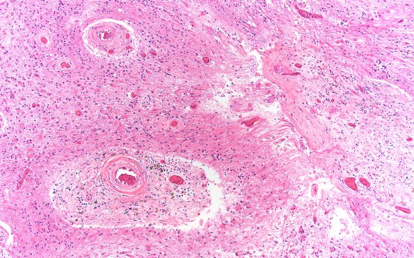 12A4 Radiation Encephalopathy (Case 12) H&E 10X 1