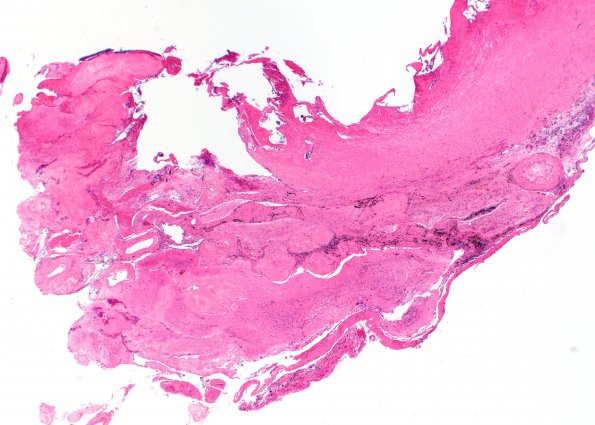 13A1 Radiation Necrosis of AVM 10 years after Rx (Case 13) H&E C1 2X copy